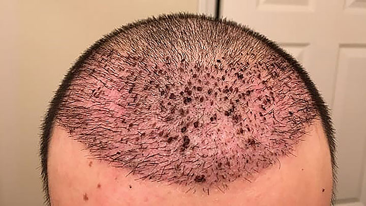 کندن دلمه های بعد از کاشت مو