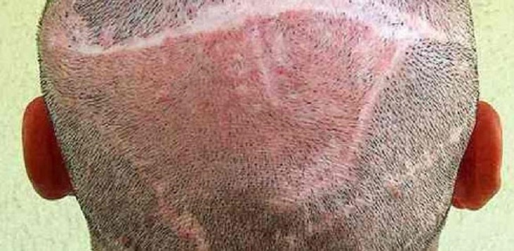 علائم عفونت بعد از کاشت مو