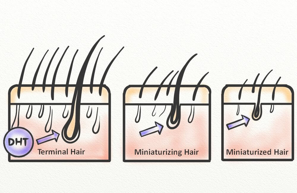 درمان ریزش مو تستوسترون