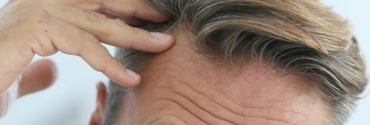 hereditary hair loss